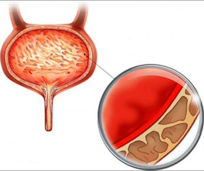 Cystitis inflammation