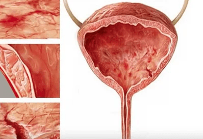 The reasons for the development of cystitis in women